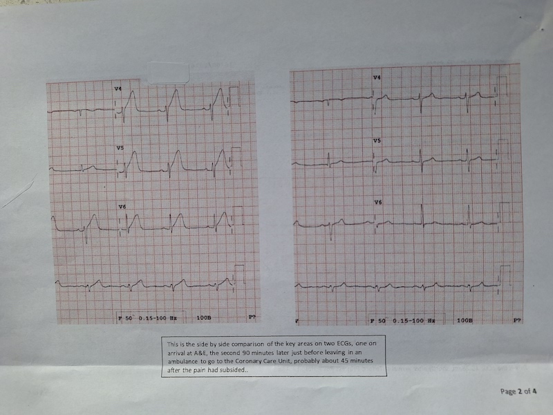 ekg